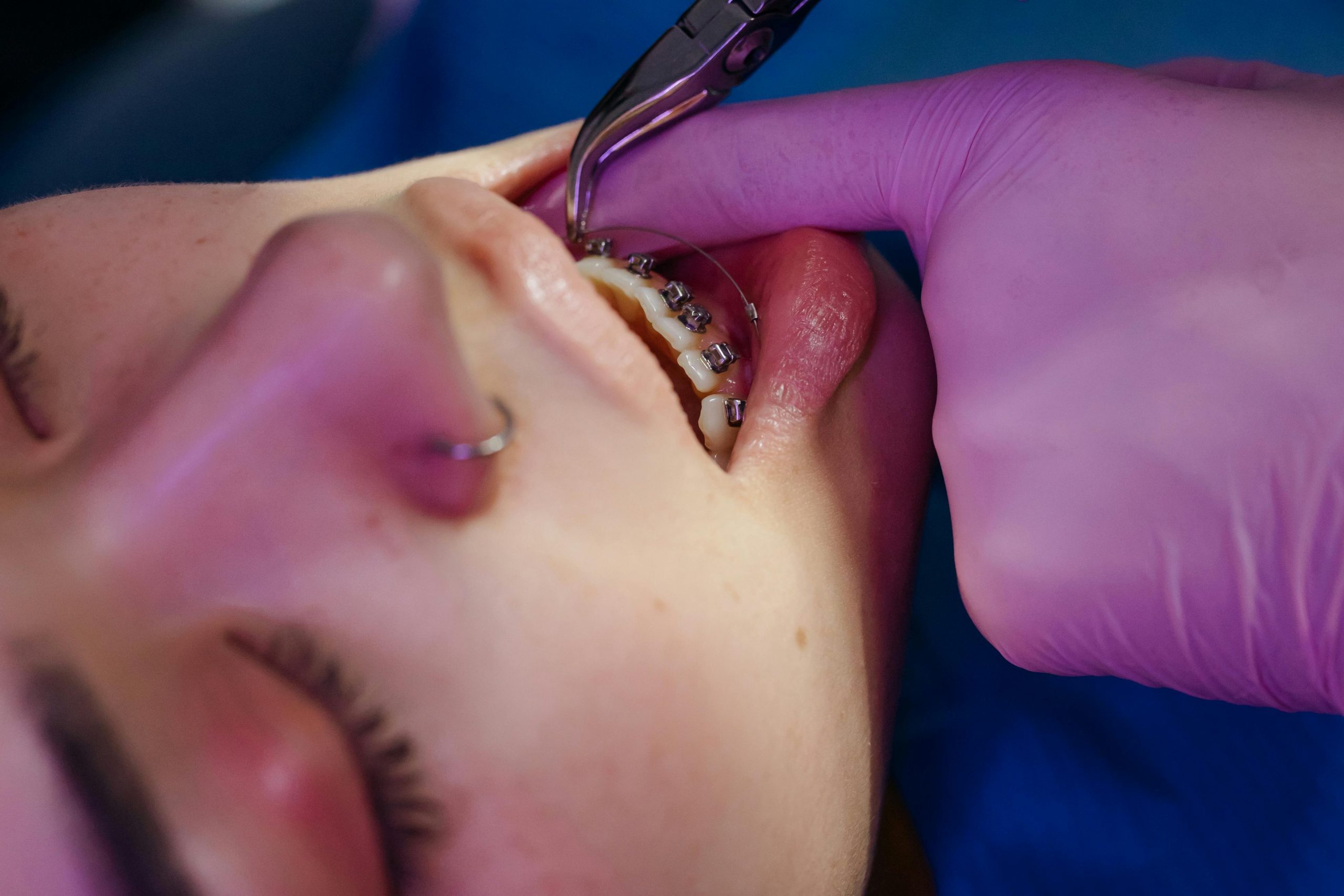 dentist attaching metal braces brackets onto a patient's front teeth