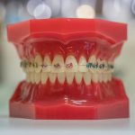 dental model with braces