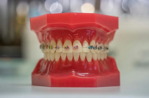 dental model with braces
