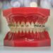 dental model with braces